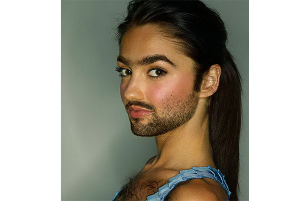 Chứng rậm lông - Hình ảnh minh họa